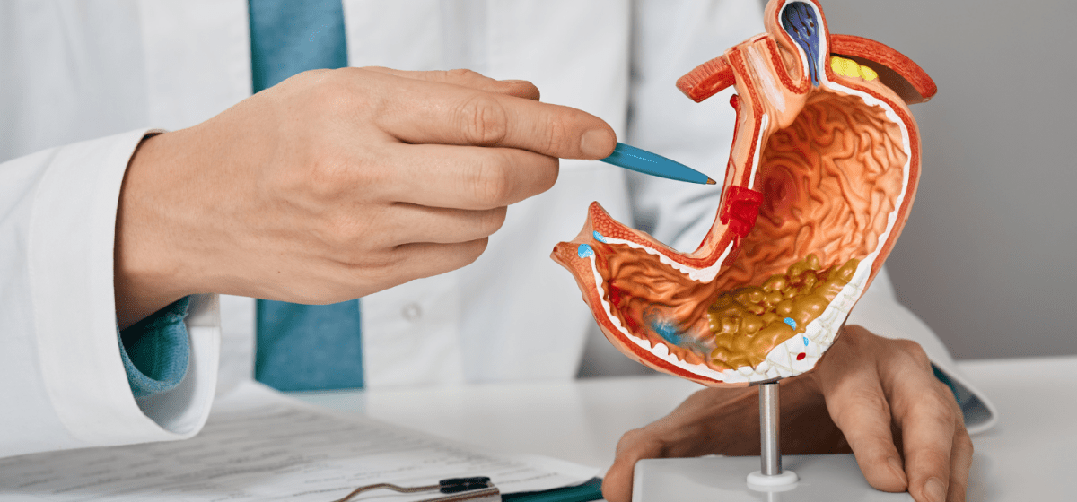 Palloncino Gastrico Avellino