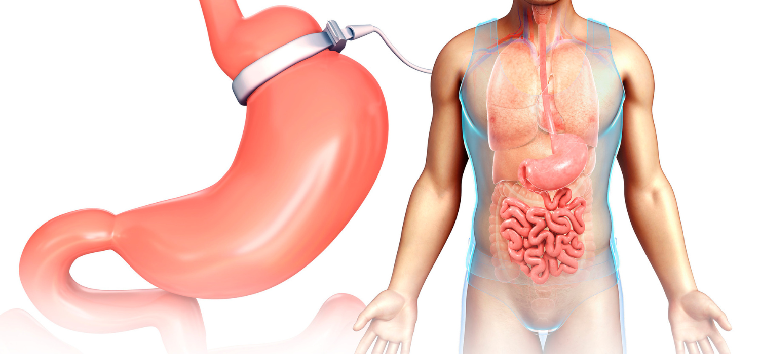 Palloncino Gastrico Benevento