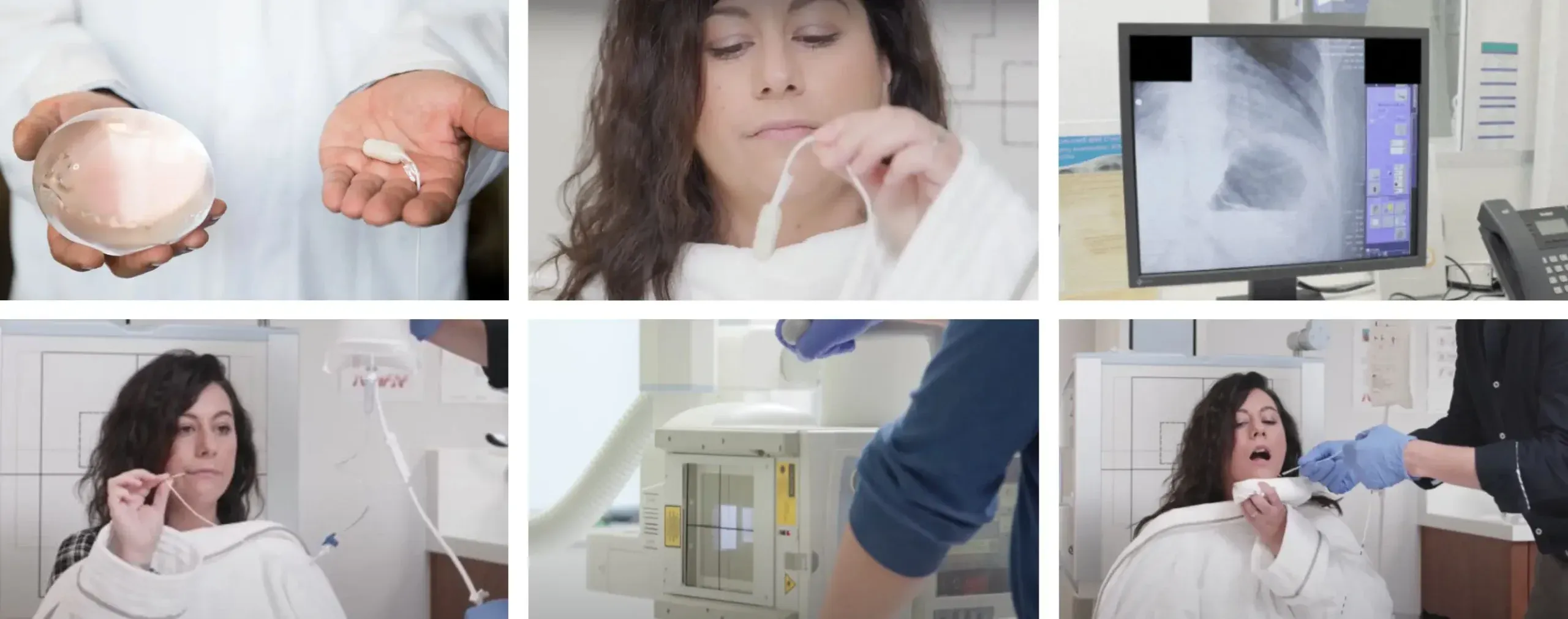 Palloncino Gastrico Stella Napoli