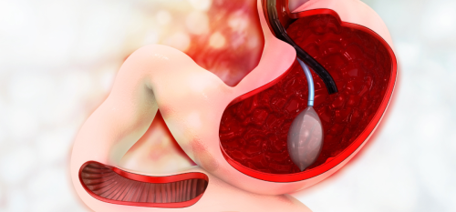 Palloncino Gastrico Napoli