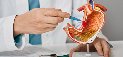 Palloncino Gastrico Avellino