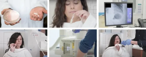 Palloncino Gastrico Stella Napoli