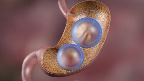 Palloncino-gastrico-stella-benevento