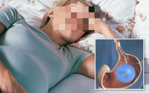 palloncino-gastrico-stella-salerno